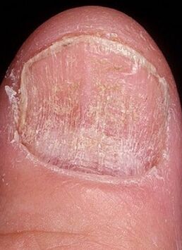 ce pot să beau pentru ciuperca unghiilor de la picioare ce antibiotice pentru ciuperca unghiilor de la picioare